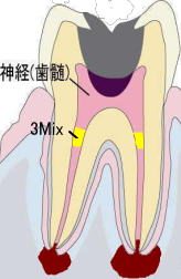 3Mix法　治療中