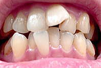 デコボコの前歯