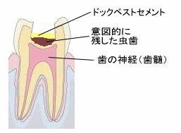 ドックベストセメント３