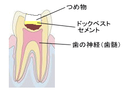 ドックベストセメント４