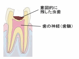 3Mix法　２