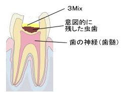 3Mix法　３