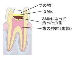 3Mix法　４